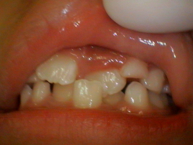 前歯反対咬合の改善