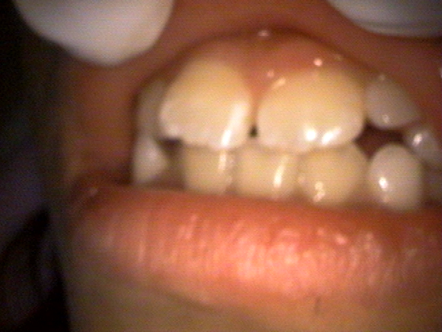 前歯反対咬合の改善 治療後